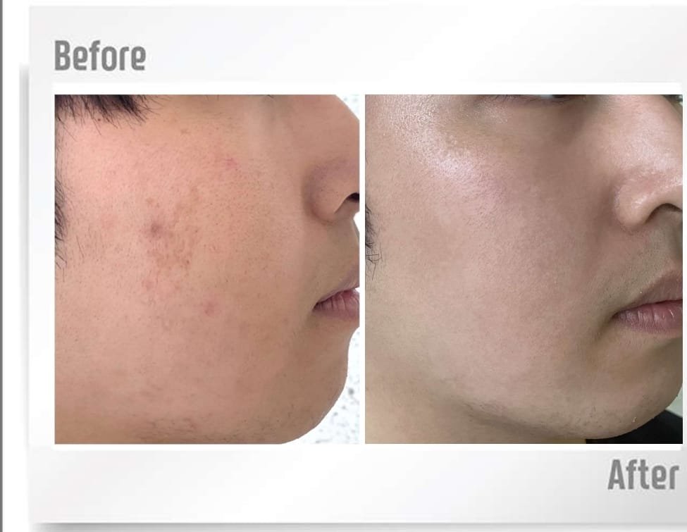haPN 70 acne scar before and after