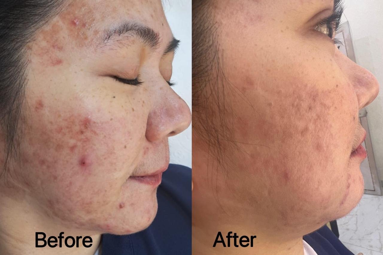 Before and after LIXOFORD-S treatment for acne and skin clarity