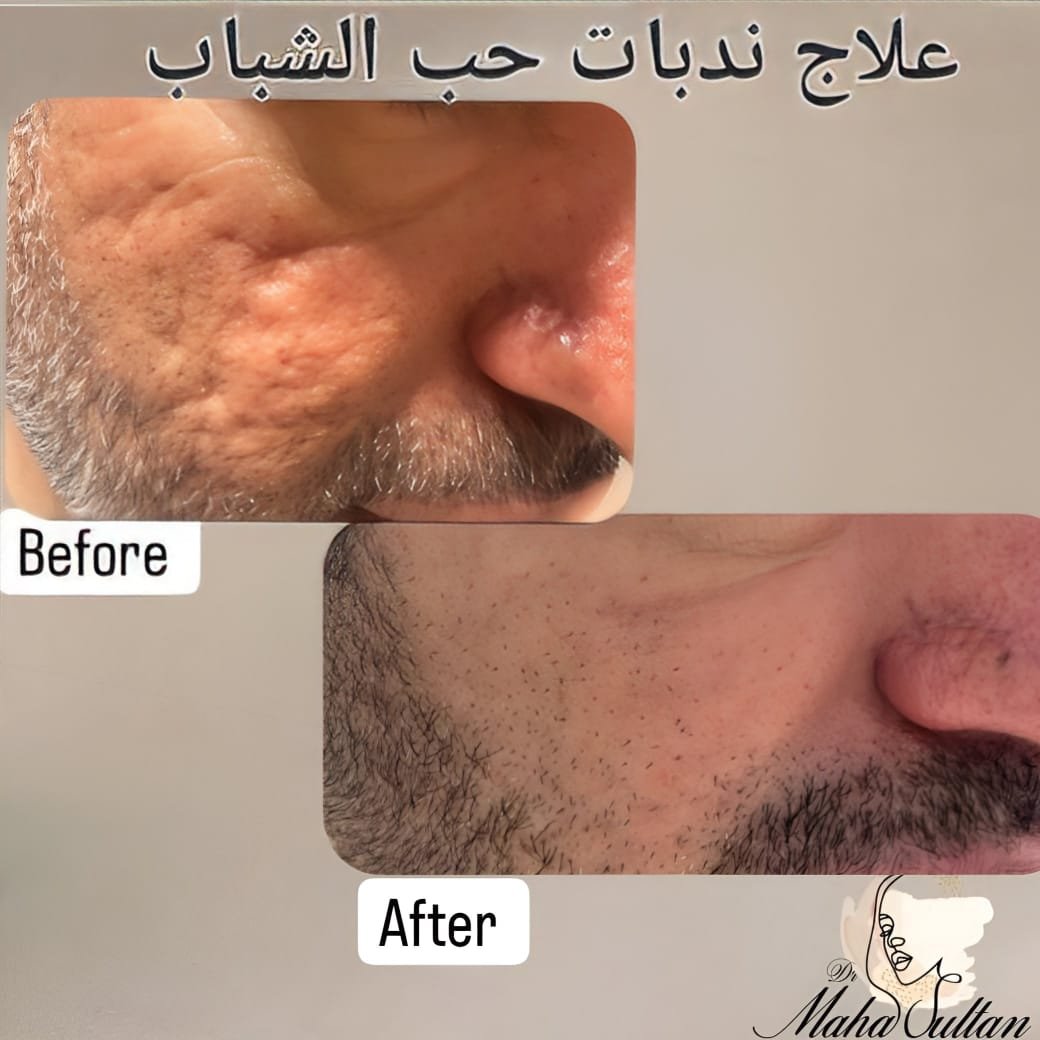 Before and after LIXOFORD-S treatment for acne scars